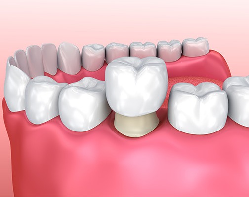 Illustration of a CEREC same-day dental crown in Brookline, MA being placed