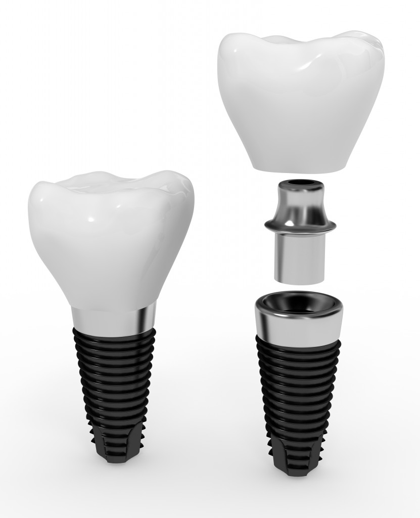 dr-sasson-dental-implants-boston-boston-smile-center-blog