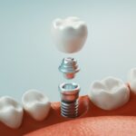 Are you a candidate for dental implants in Boston?