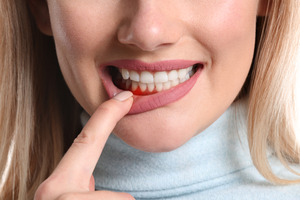 Woman pulling down lip to show gums